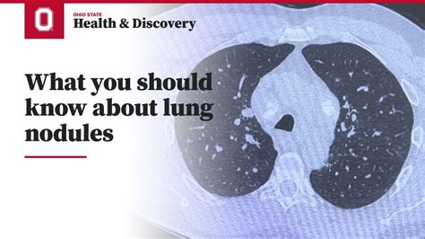 When to Worry About Lung Nodules or a Spot on the Lungs.
